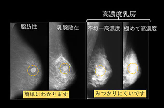 マンモグラフィ検査は「高濃度乳房」の場合、判明が困難です