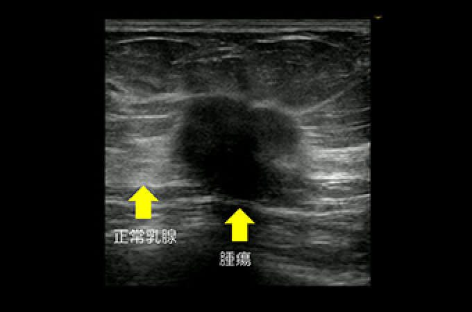 エコー（超音波）検査は「高濃度乳房」の方にも有用です